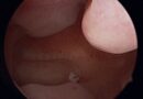 Pólipos Endometriais