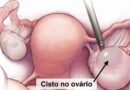 Cistos Ovarianos