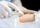 Implante Contraceptivo Subdérmico (Implanon®)