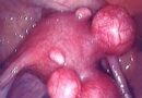 Leiomiomas Uterinos